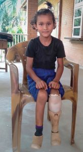 Having suffered for eight years, Binsa is now recovering after life-changing surgery and the receipt of a new prosthetic.